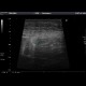 Sclerosing mesenteritis: US - Ultrasound